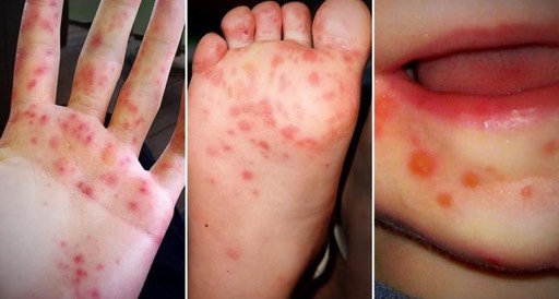 374d6729-abe9-409c-94f2-cc3dbed7bb1d-large16x9 handfootmouthdisease