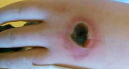 a-student-was-burnt-after_med_hr