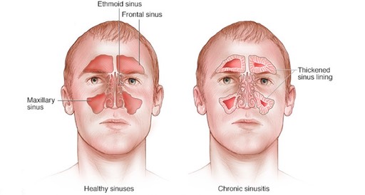 mcdc7_chronic_sinusitis_med_hr